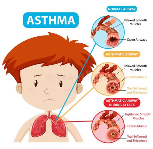 asthma